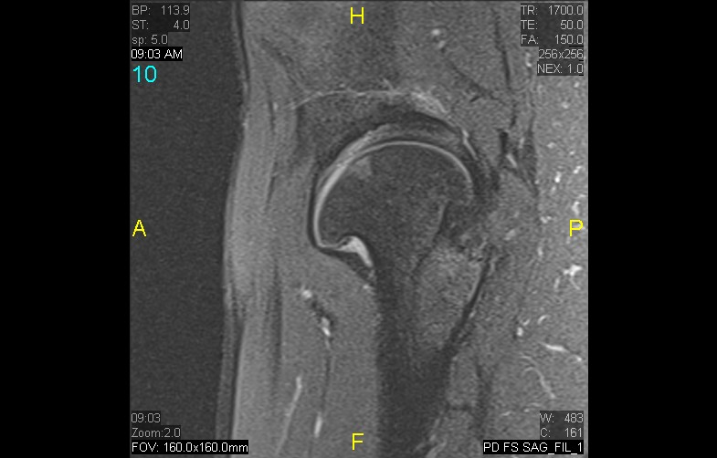 Figure 5 for case History Perthes Disease